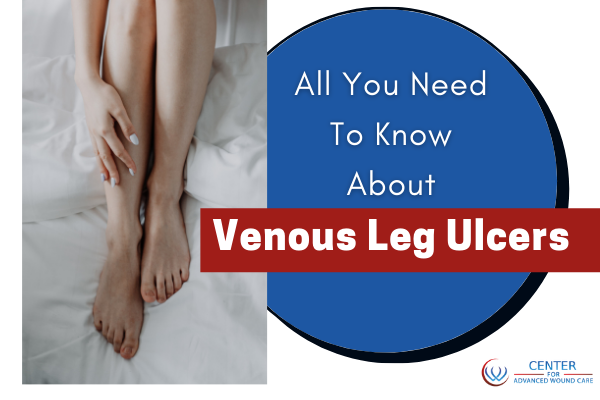 Venous leg ulcers camarillo