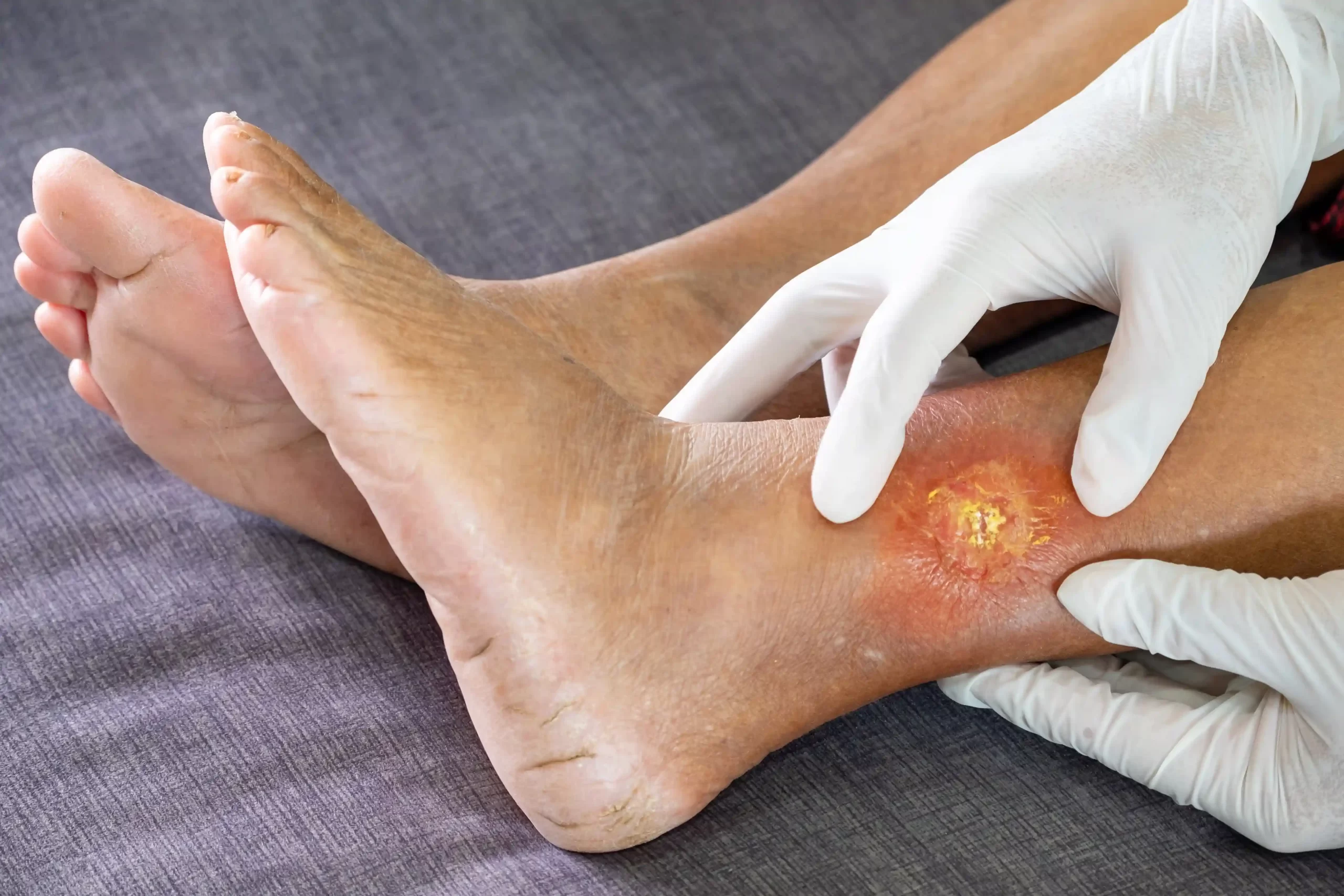 A Doctor wearing gloves is examining an arterial leg ulcer on a patient’s ankle, showing early symptoms of an arterial ulcer wound.