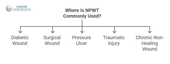 Flowchart illustrating common uses of Negative Pressure Wound Therapy, including diabetic wounds, surgical wounds, pressure ulcers, traumatic injuries, and chronic non-healing wounds.